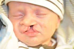 Cleft Lip and Palate in Cleveland, OH