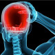 Occipital Trigger Point Surgery in Cleveland