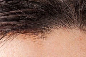 Hair Transplant Treatment in Cleveland