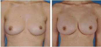 breast-aug