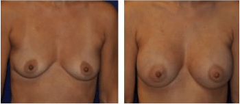 breast-aug2