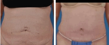 tummytuck