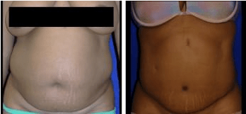 tummytuck2