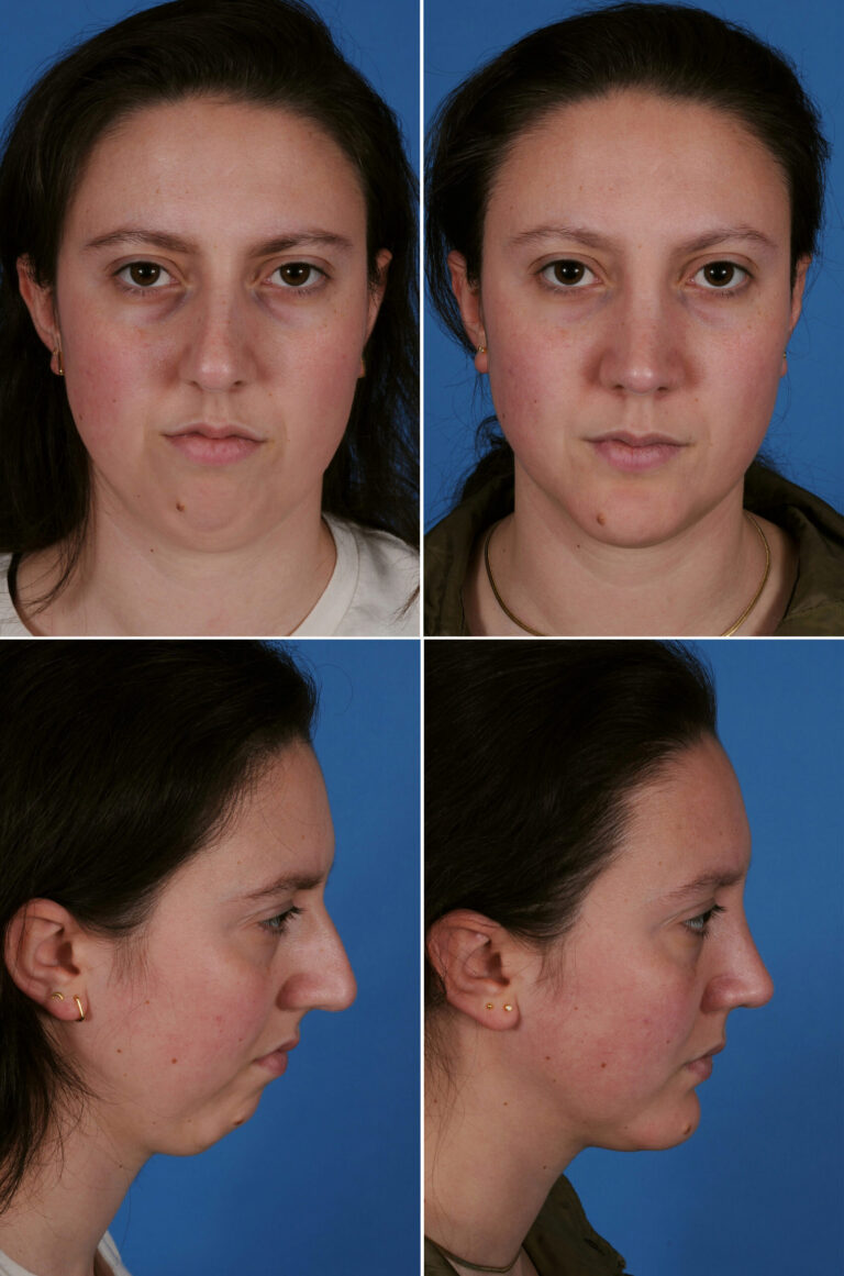 114746-case-4-rhino-genio-before-and-after-scaled-1