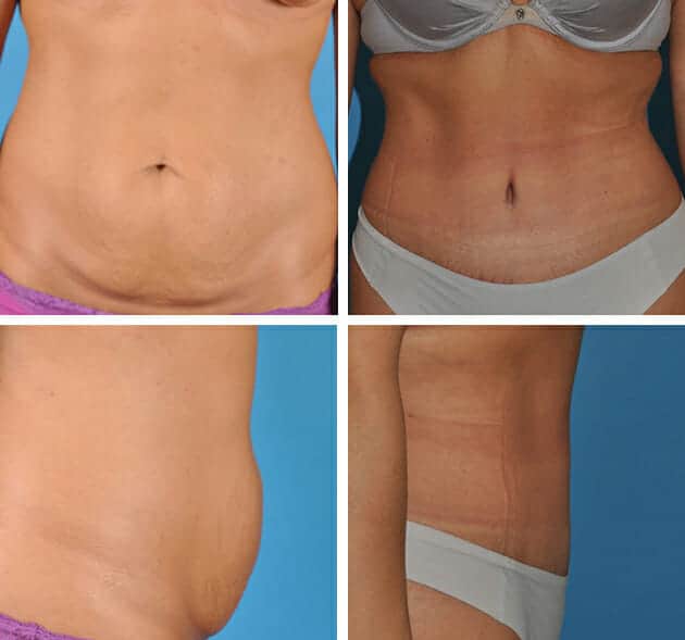 abdominoplasty-001