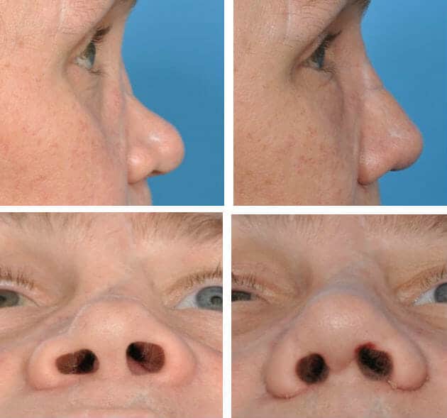 best-rhinoplasty-surgeon-in-united-states