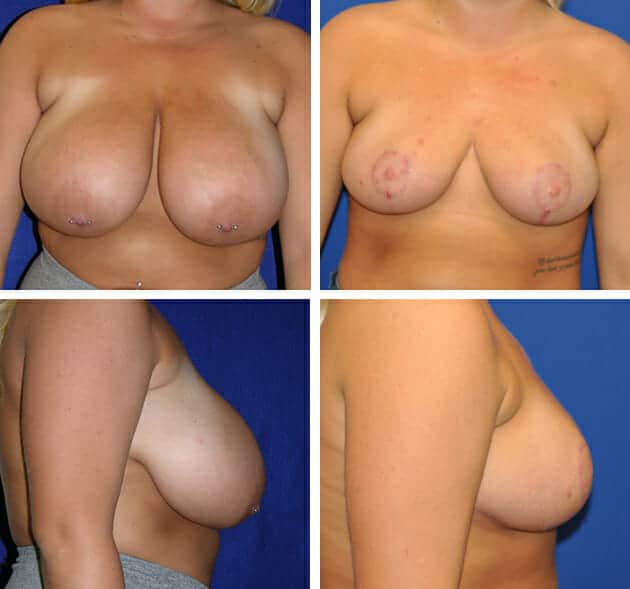 breast-reduction-001