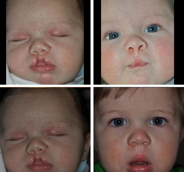 cleft-59278