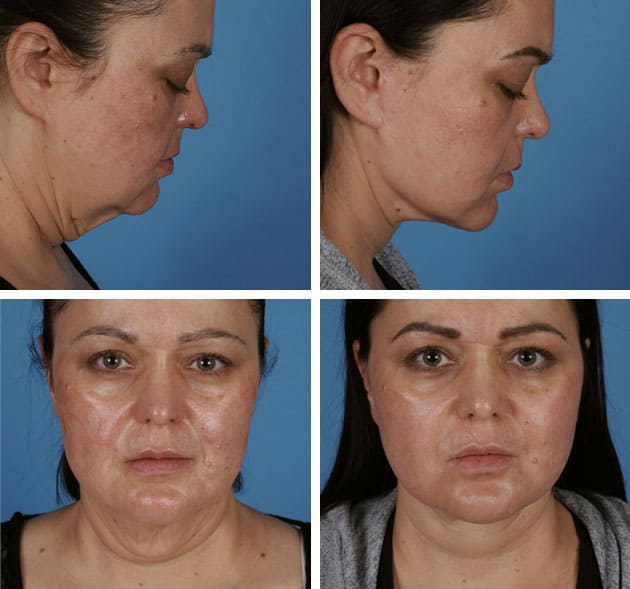 face-neck-lift-43759-1
