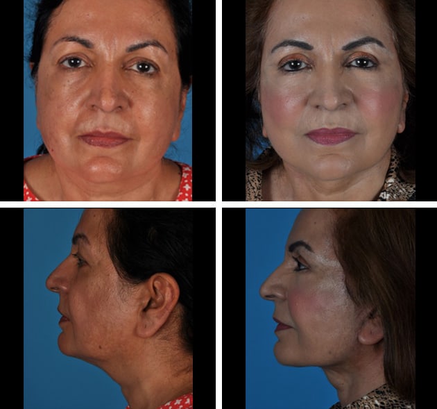 face-neck-lift-patient-43756