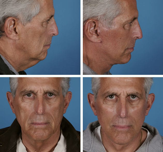facelift-necklift-43758