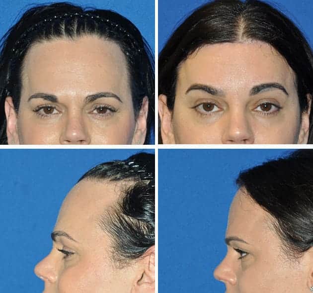 forehead-2