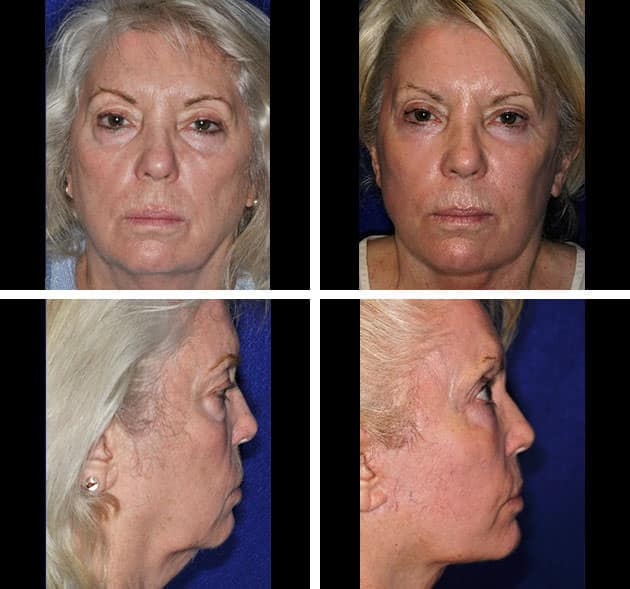 neckLift