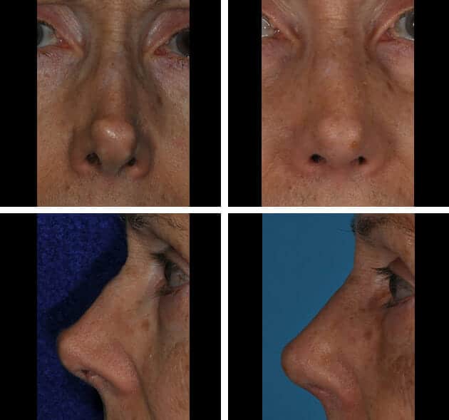 tip-rhinoplasty-case-2