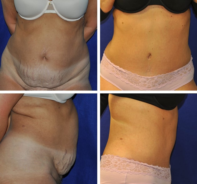 tummy-tuck-patient-15049