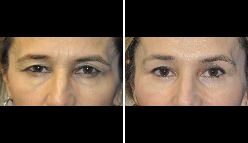 126064-bleph-closeup-before-and-after-case-1
