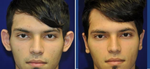 best-Otoplasty